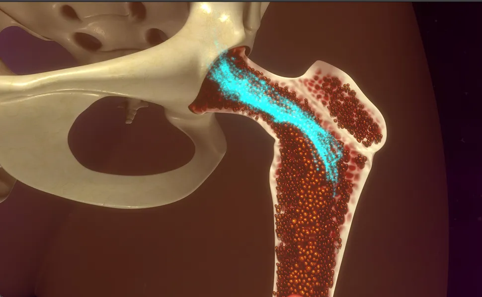 What Is Secondary Myelofibrosis?  image