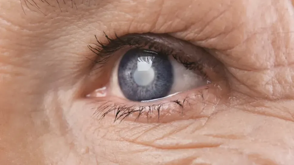 Does Dexamethasone Cause Cataracts? image