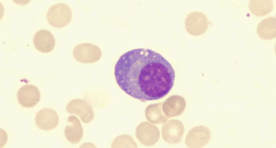 A New Potential Stage of Precursor Condition in Multiple Myeloma image