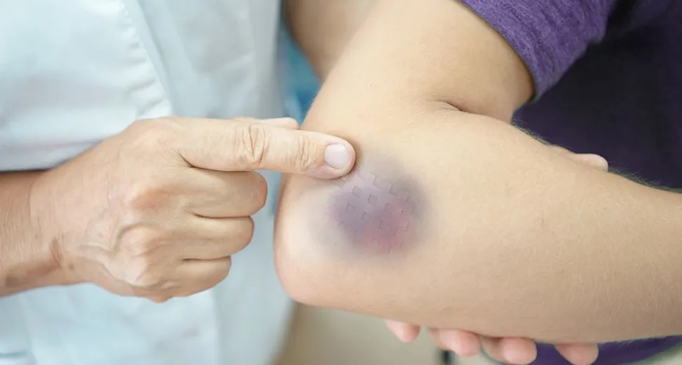 CLL Side Effect Management: Bruising - HealthTree for Chronic Lymphocytic Leukemia