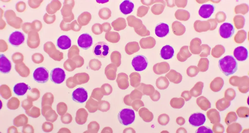 Discussing Unmet Clinical Needs in CLL with Silvia Deaglio, MD, PhD image