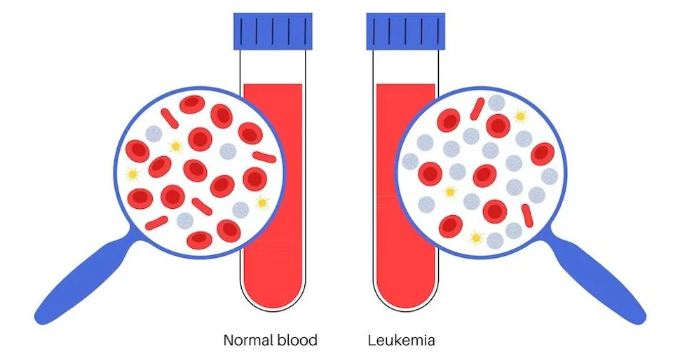 What Is The Difference Between Chronic And Acute Leukemia? image