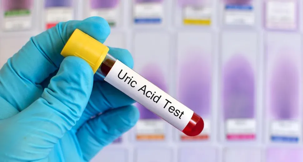 Tests for CLL Patients: Uric Acid image