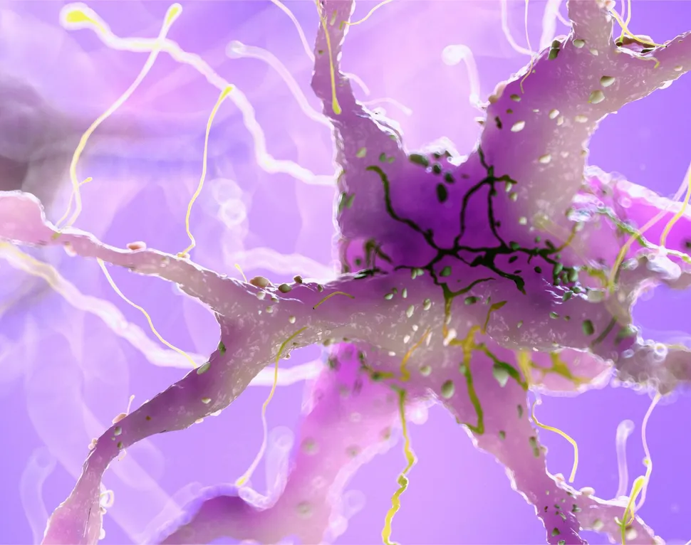 Efectos secundarios del mieloma múltiple: Neuropatía image