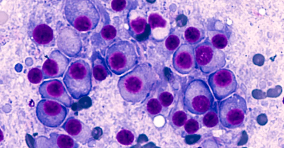 ASH 2017: Myeloma Experts' Favorite ASH Abstract Pick by Dr. Ola Landgren image