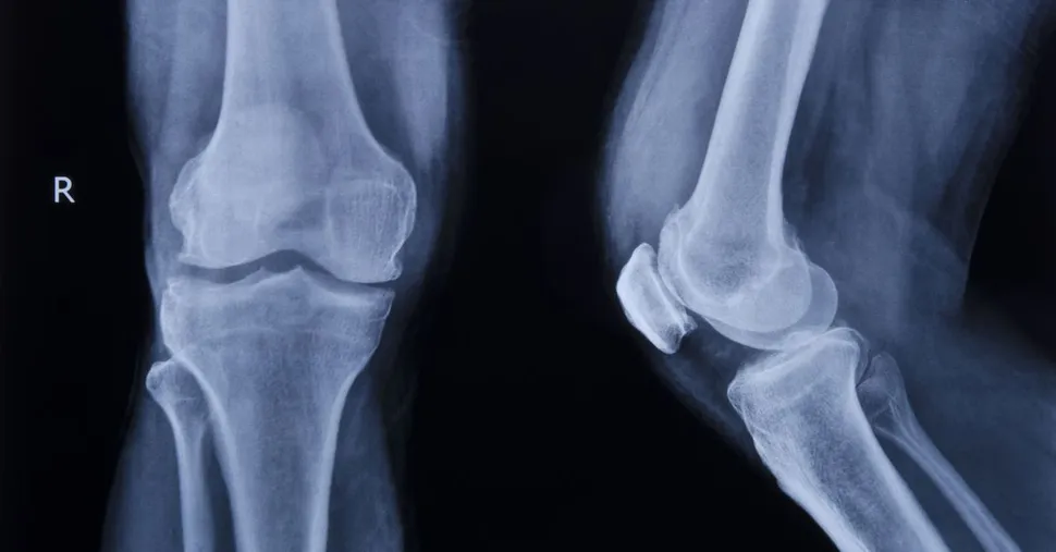 FDA Approves Denosumab Bone Strengthener for Myeloma Patients image