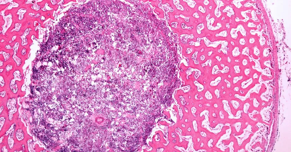 The Role of the Bone Marrow Environment in MGUS or Smoldering Myeloma Progression image