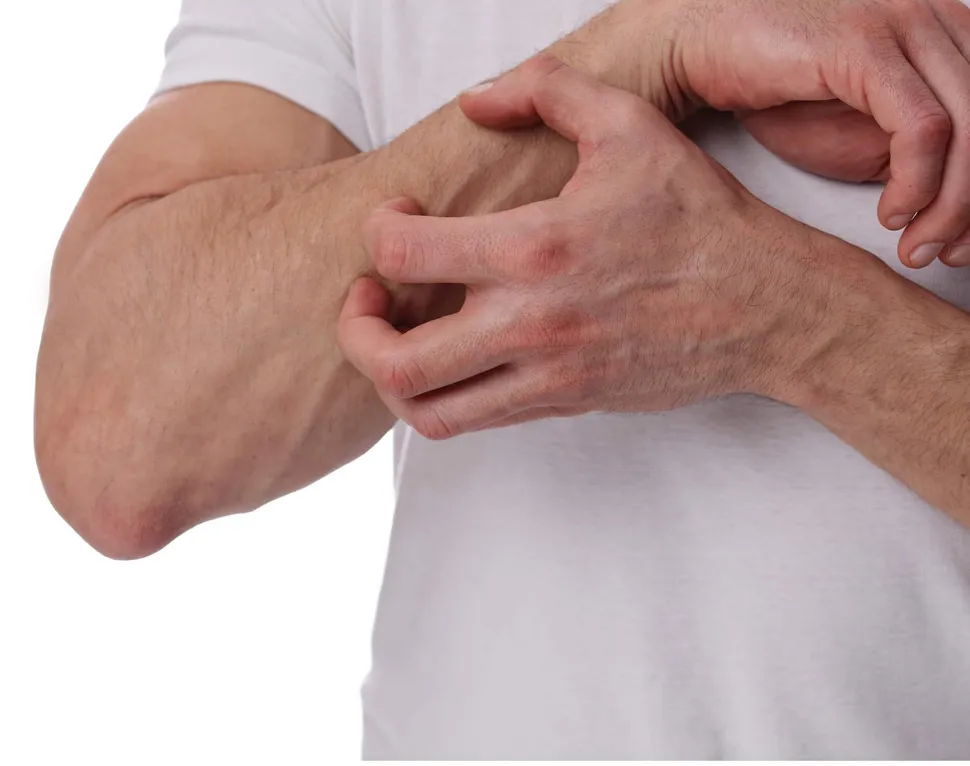 Allergic to Your Myeloma Meds? How One Mayo Clinic Patient Overcame a Pomalidomide Allergy image