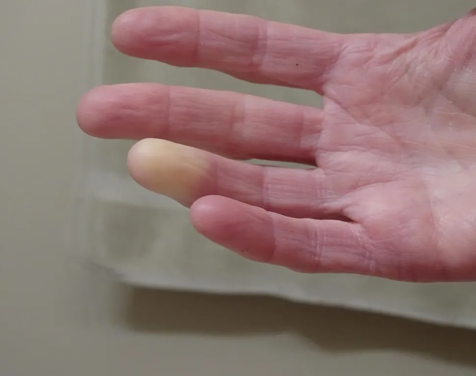 Raynaud's Disease and Myeloma… How to Cope image