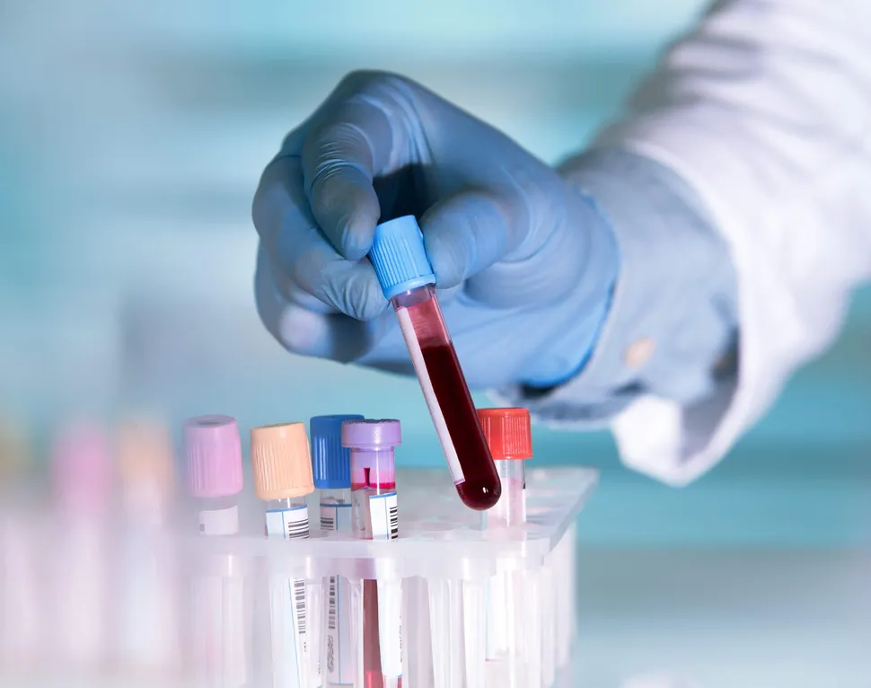 New Study Finds that Myeloma Can Be Detected by Simple Blood Tests image