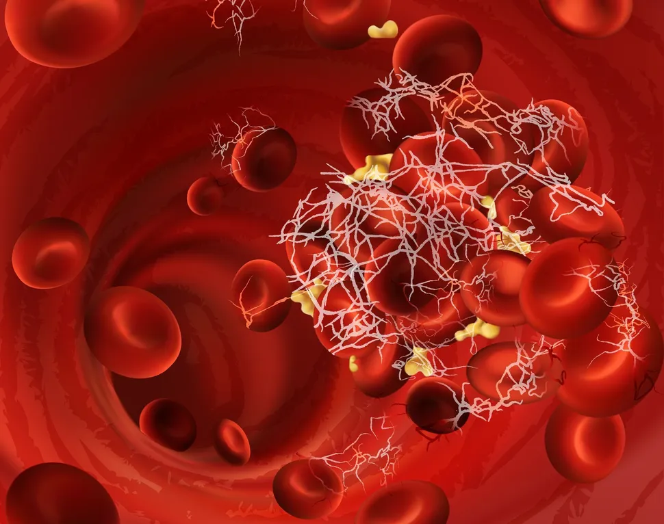 New Tool to Predict And Prevent Blood Clots in Multiple Myeloma Patients image