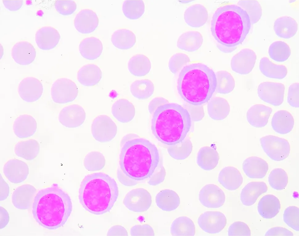 Something New to Learn in Multiple Myeloma: Invariant Natural Killer T-Cells (iNKT) image