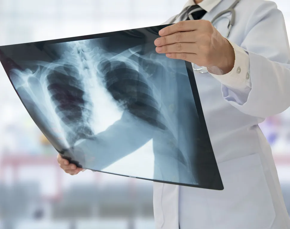 Earlier Detection of Multiple Myeloma Prevents Bone Damage and Extends Life image