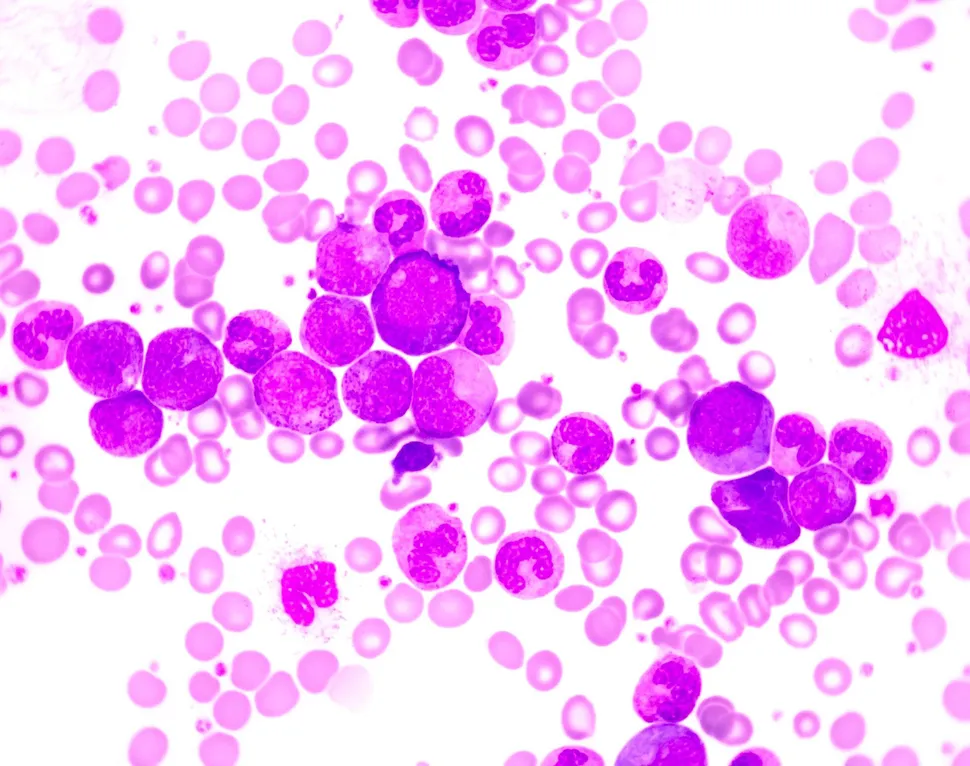 Multiple Myeloma Treatment and Secondary Cancers image