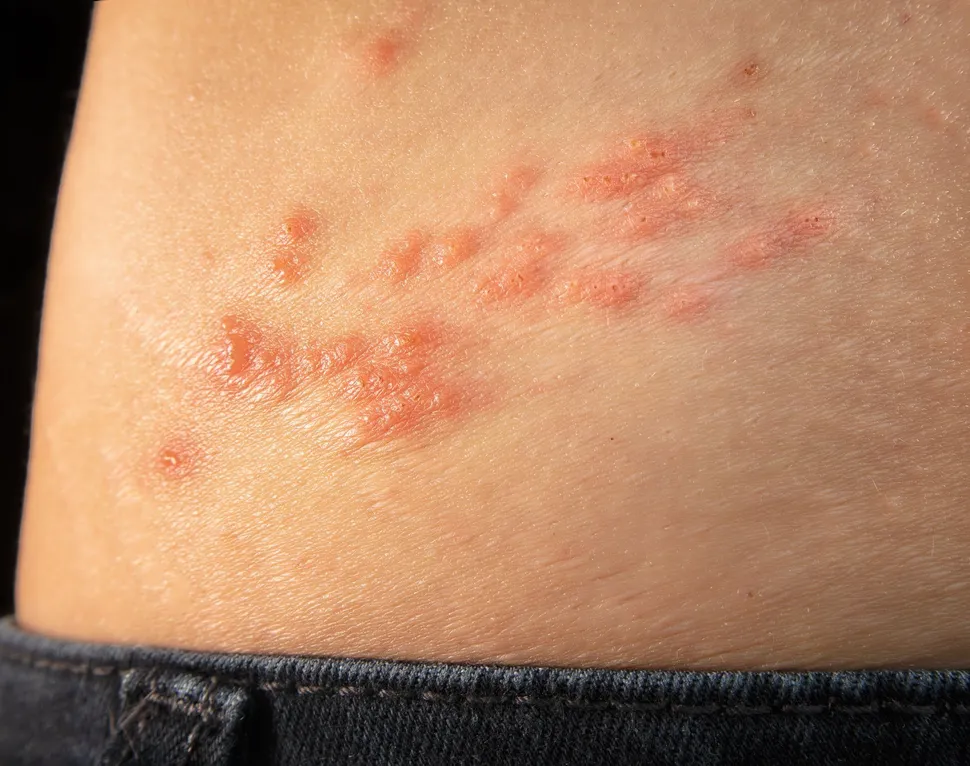 Multiple Myeloma, Stem Cell Transplants and ...Shingles image