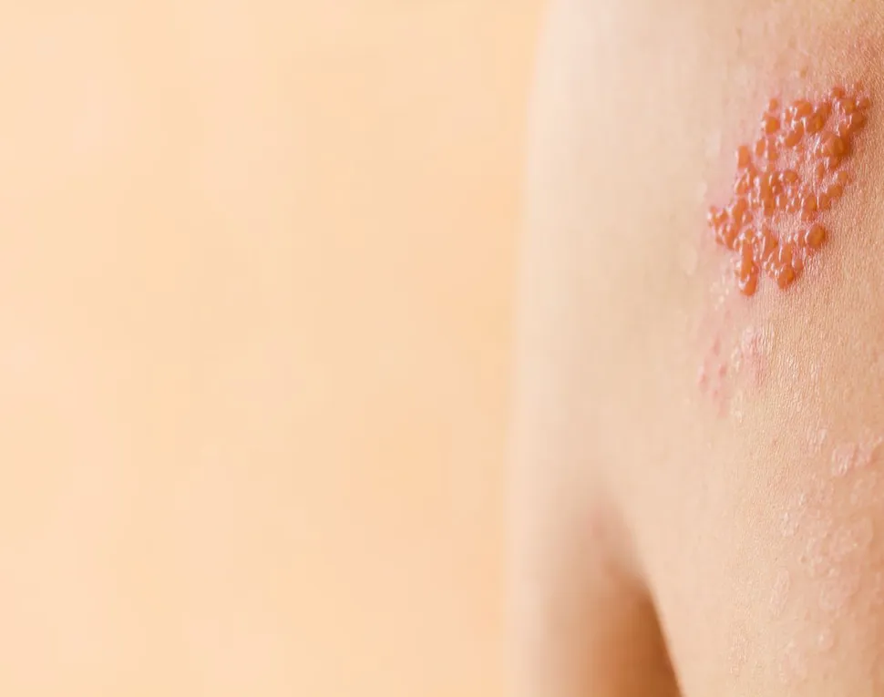 New Vaccine Reduces Complications of Chicken Pox and Mono-Related Virus in Transplant Multiple Myeloma Patients image