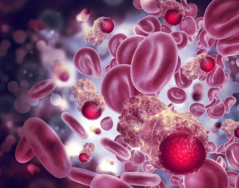 A Prior Cancer Diagnosis and Later Development of Multiple Myeloma image