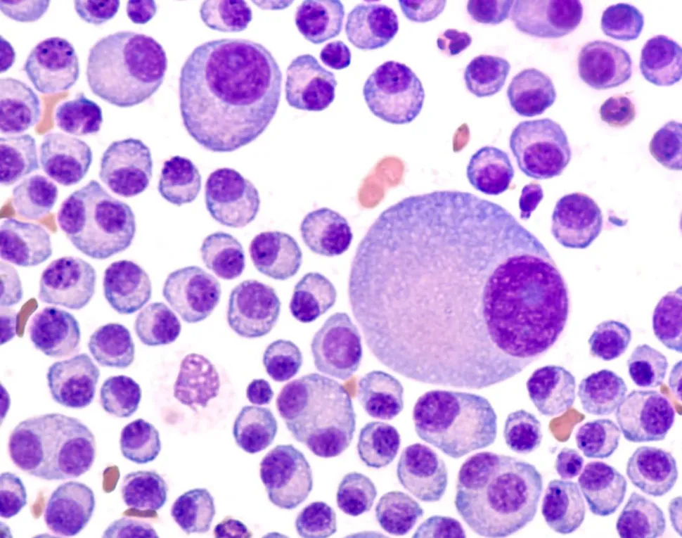 What Is Multiple Myeloma and Where Can I Find Help? image