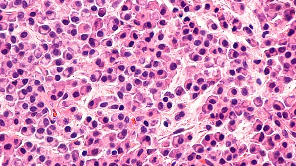 La enfermedad residual mínima negativa se convierte en el nuevo objetivo final del tratamiento del mieloma image