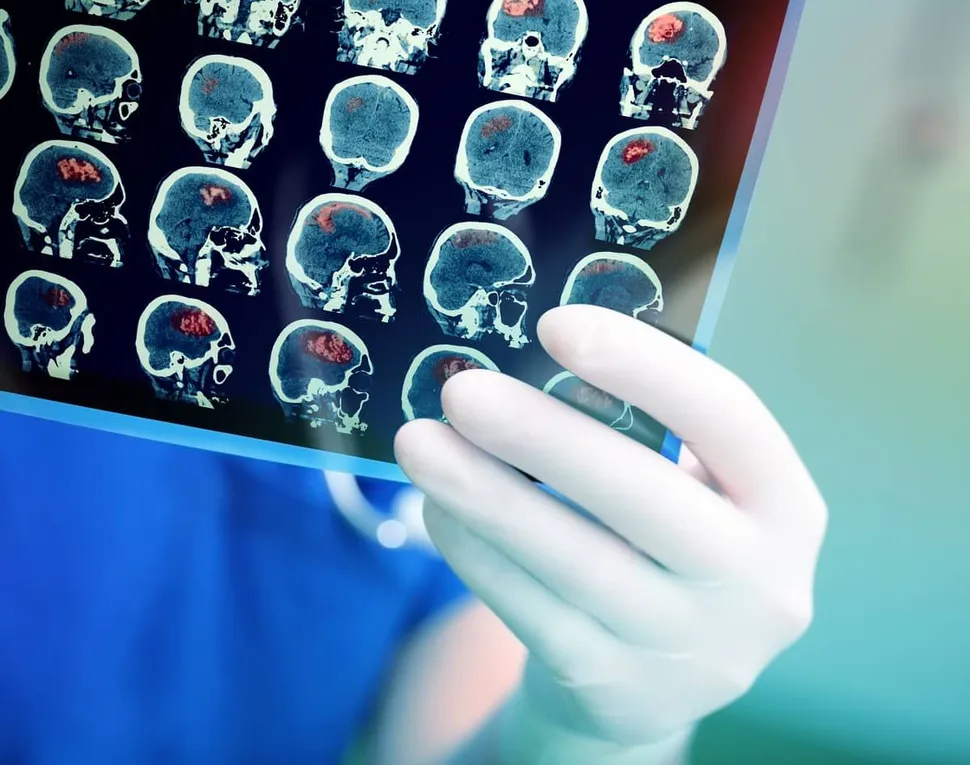 A Non-Secretory Myeloma Patient's Outstanding Experience with a New ALK Inhibitor image
