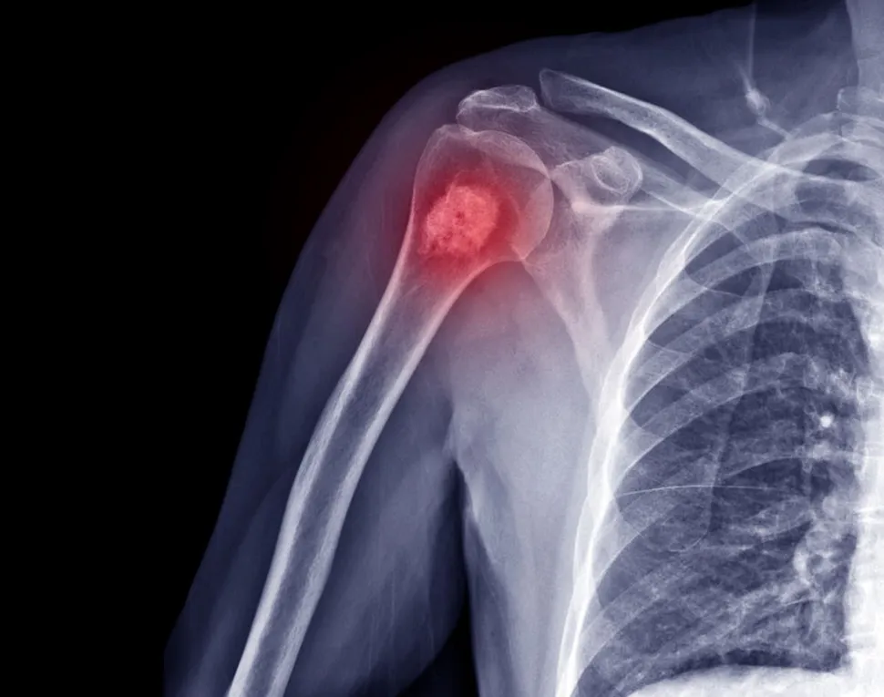 HealthTree University: Multiple Myeloma Basics Part 2 (2 of 2) image