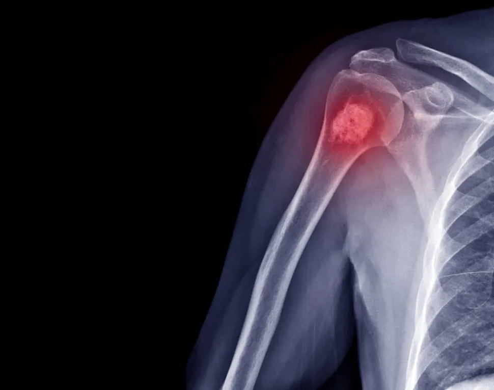 Unraveling a Multiple Myeloma Mystery by Studying Bone Lesions image