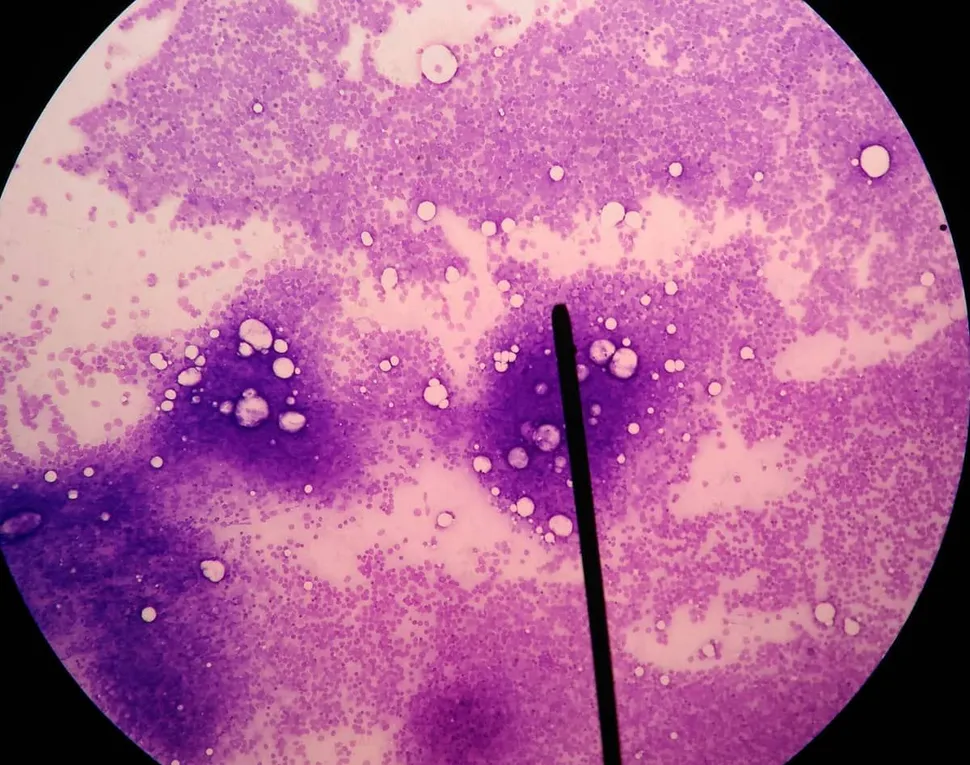 How are Free Light Chains Measured? Why Get a Bone Marrow Biopsy image