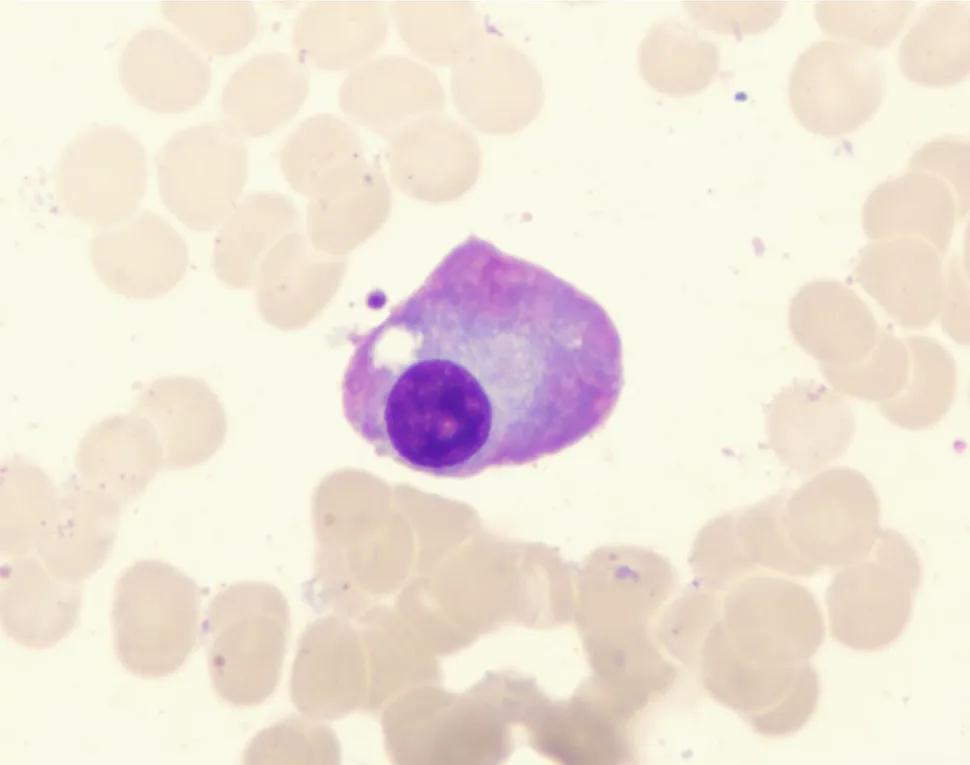 ASCO 2020: High-Risk Disease Progress Continues Despite Uncertainties image