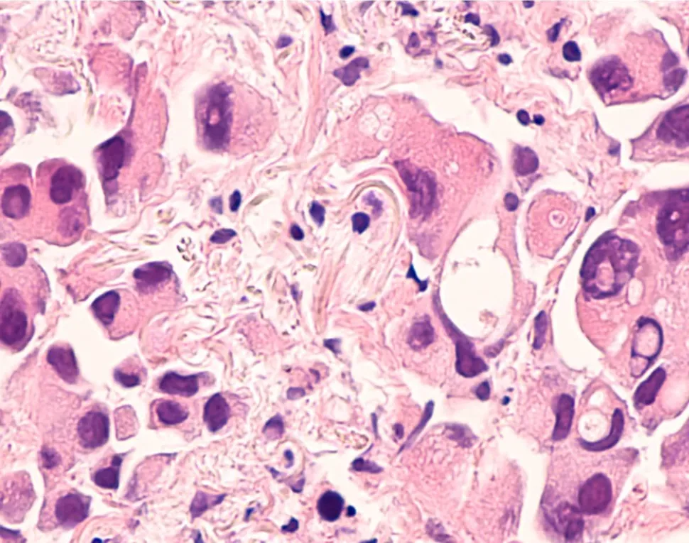 A New Treatment Option for Relapsed Myeloma Targeting MAPK Signaling image