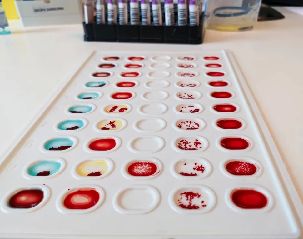 Blood Type and Multiple Myeloma Outcomes image
